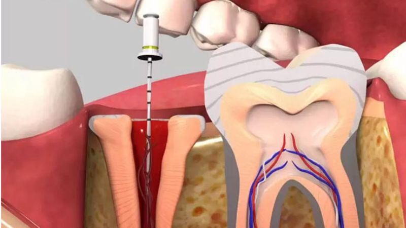 Lấy tủy răng bọc sứ giá bao nhiêu? Bảng giá mới nhất 3