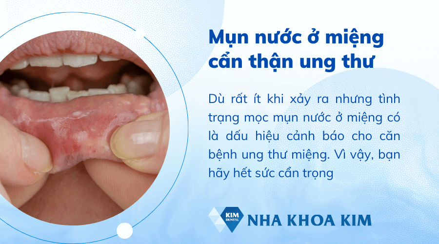 Mụn nước trong miệng là bệnh gì?