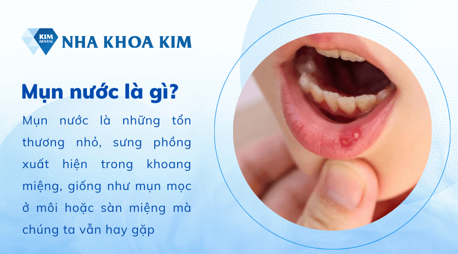 Mụn nước trong miệng là gì?