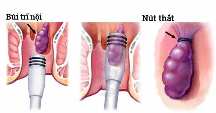 Phương pháp PPH mang nhiều nhược điểm hơn cả