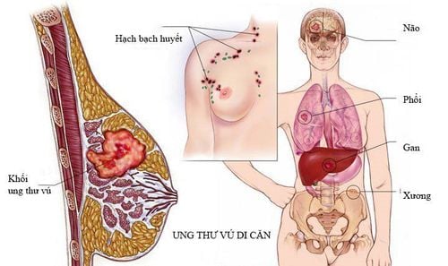 Hình ảnh ung thư vú di căn lên não